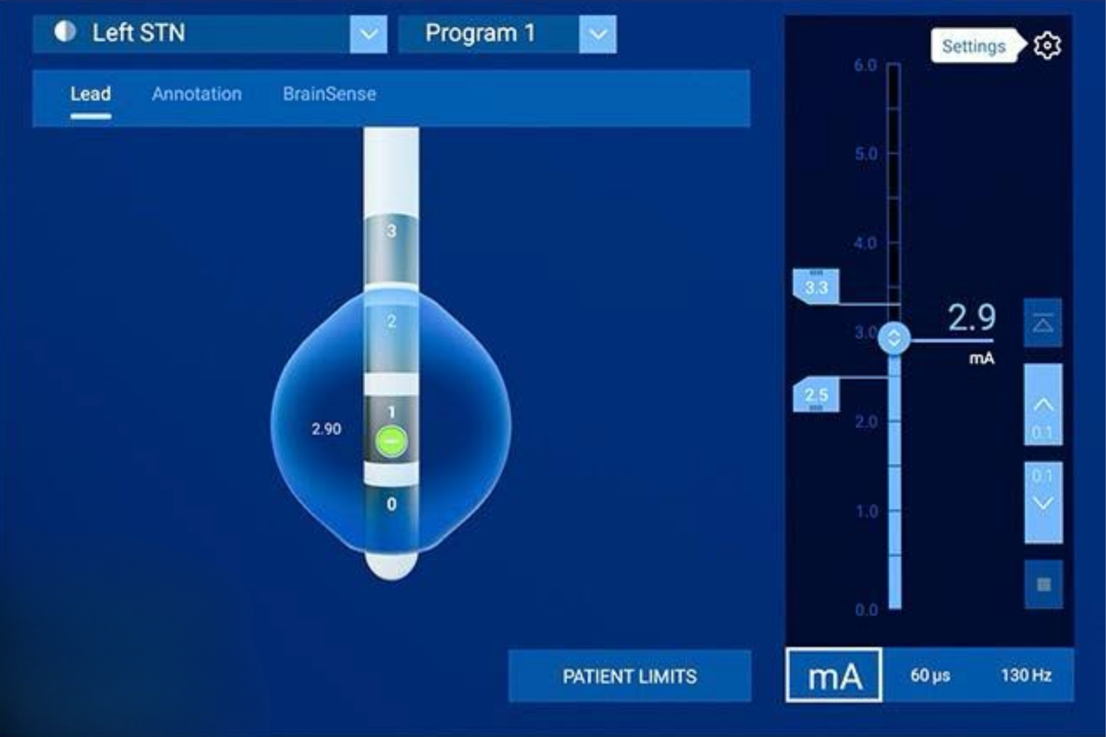Estimulación cerebral profunda (DBS) – Vista general - Médica Sur Copyright